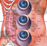 moxibustion