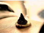 moxibustion